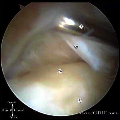 Type 2 Biceps Labral Complex 