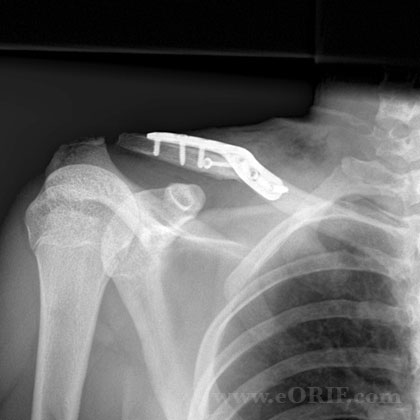 clavicle fracture surgery xray