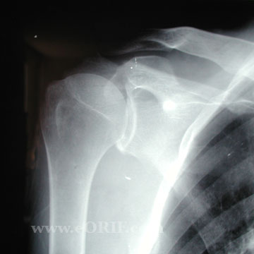 Acromion fracture A/P xray