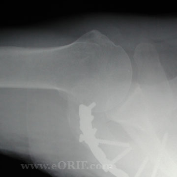 Acromion fracture ORIF axillary xray