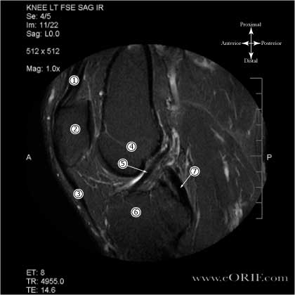 Inversion Recovery MRI of Normal ACL