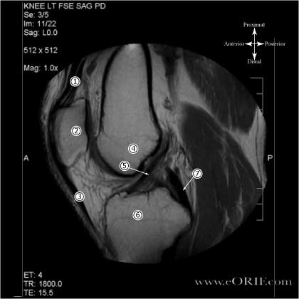 Proton Density MRI of Normal ACL
