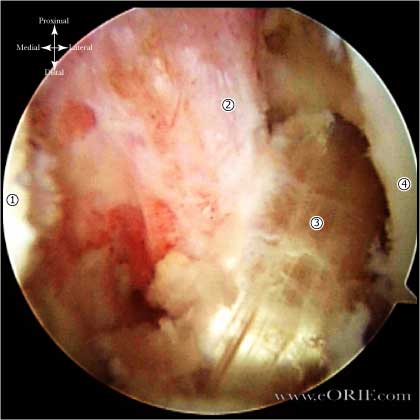arthroscopic ACL reconstruction picture
