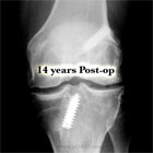 ACL reconstruction post-op image