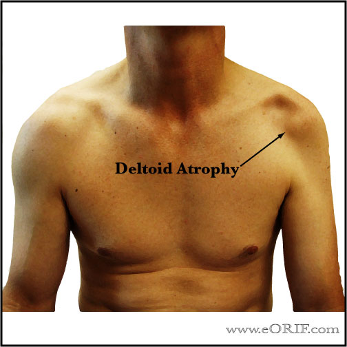 deltoid atrophy picture