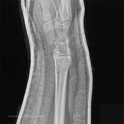lateral view closed reduction x-ray pediatric distal radius fracture