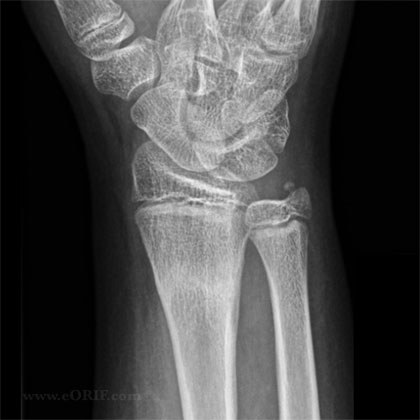 distal radius fracture with normal healing xray