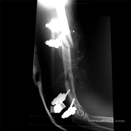 humerus fracture xray