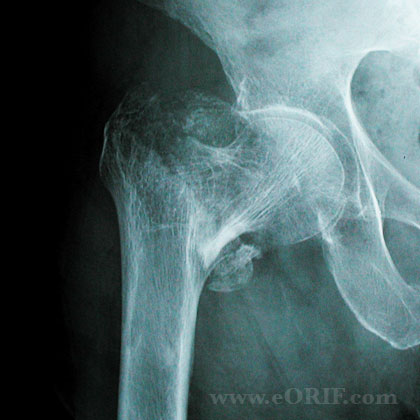 Osteoporosis hip fracture xray