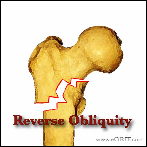 Reverse oblique intertrochanteric femur fracture image
