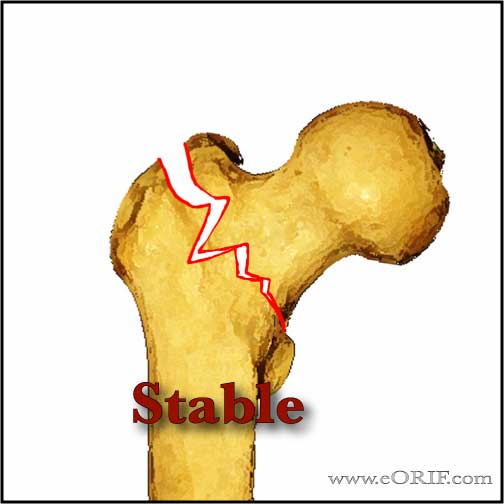Stable intertrochanteric femur fracture image