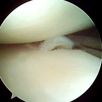 Radial Meniscal Tear picture