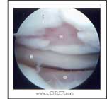 Grade IV chondral injury image