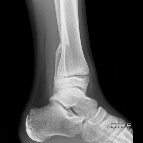 icd 10 code stress fracture left tibia