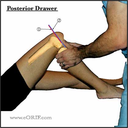 positive knee posterior drawer