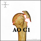 AO C1 proximal humerus fracture