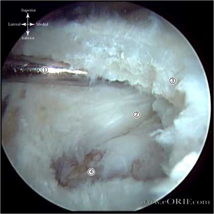 Crescent shaped RTC tear image