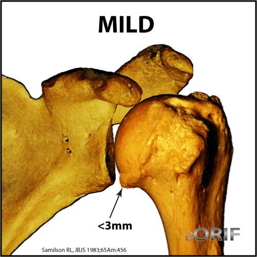 Shoulder-arthritis-mild