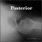 Posterior shoulder dislocation x-ray