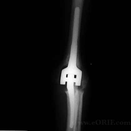 total elbow arthroplasty xray