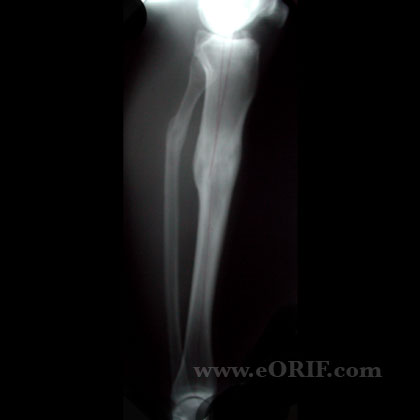 Tibial Shaft Fracture Malunion