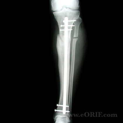 Tibial Shaft Fracture Malunion IM nail