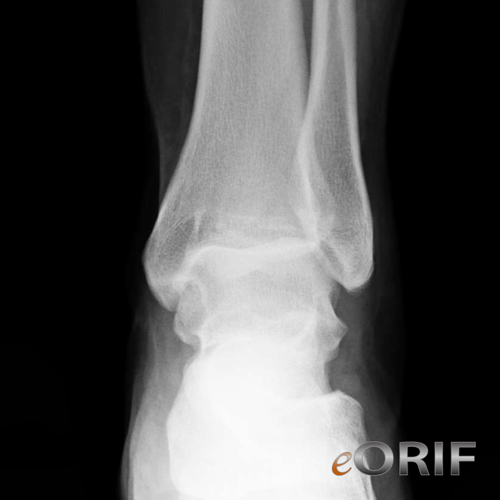 ankle dislocation xray