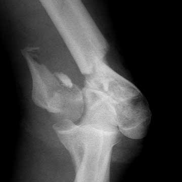 distal humerus fracture xray