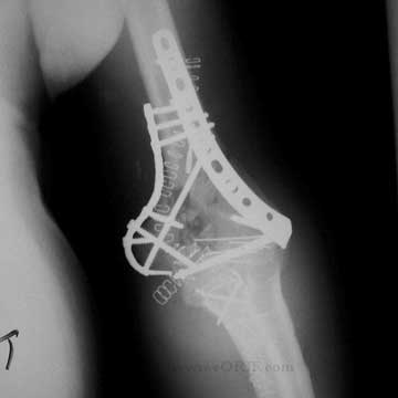 distal humerus fracture ORIF xray