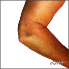 lateral elbow dislocation