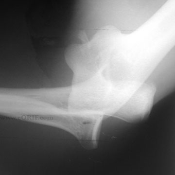 elbow dislocation xray