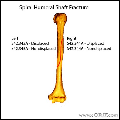 Spiral humeral shaft fracture icd-10 classification