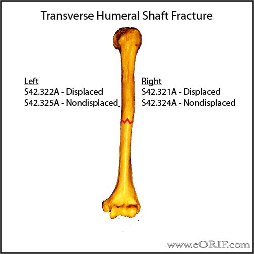 Humeral Shaft Fracture Classification | eORIF