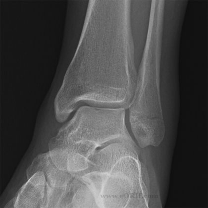 lateral malleolus fracture xray