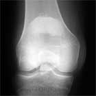 Displaced patella fracture A/P view