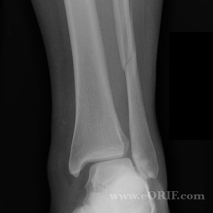 Lateral malleolus fracture syndesmosis injury xray