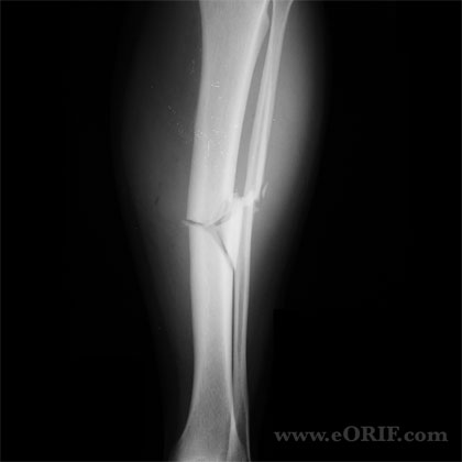 Tibial shaft fracture xray