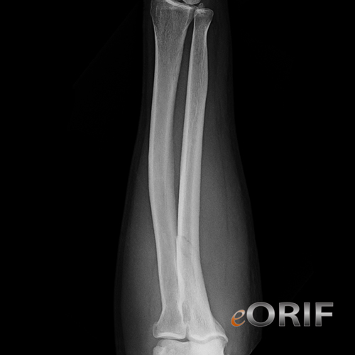 proximal ulnar shaft fracture xray 