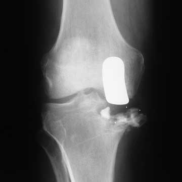 failed unicompartment knee arthroplasty