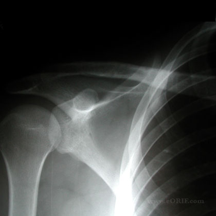 healed clavicle fracture