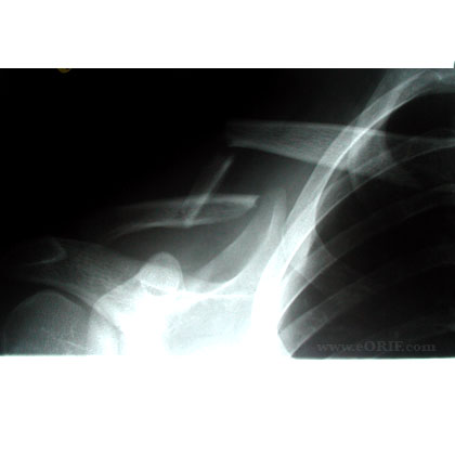 Clavicle Fracture