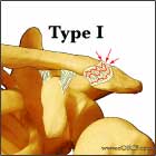 Type I acromioclavicular separation