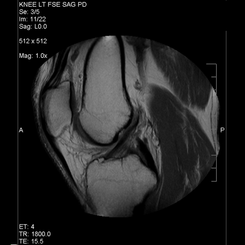 Normal ACL mri