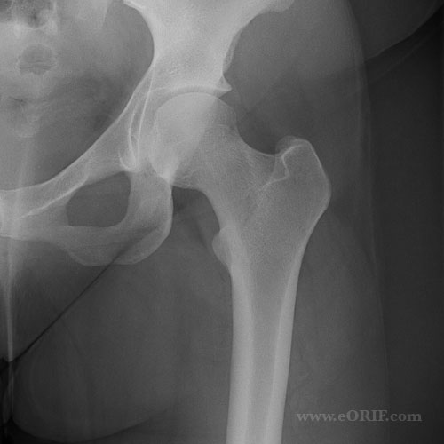 hip joint xray normal