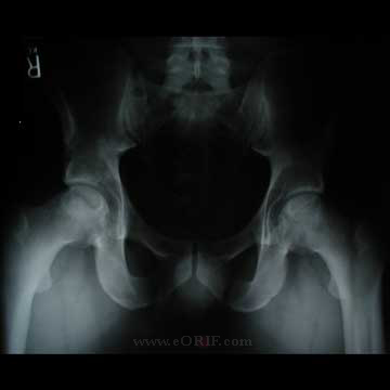 AVN of the hip Xray image