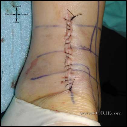 Achilles tendon incision image