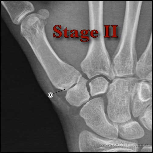 Thumb CMC osteoarthritis Stage II xray