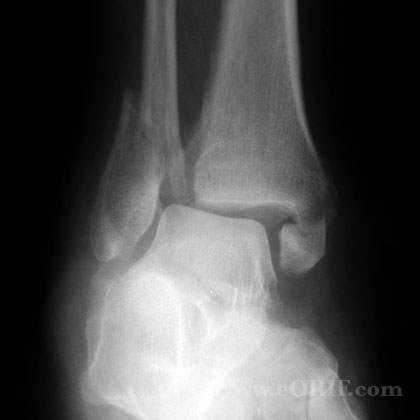 Displaced bimalleolar ankle fracture xray