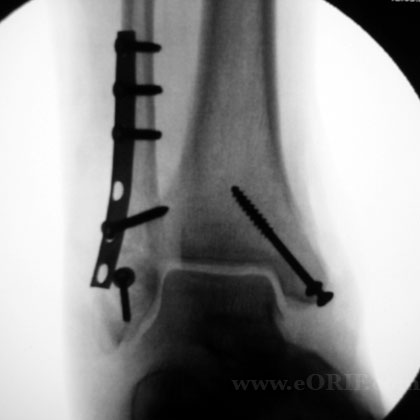 bimalleolar ankle fracture surgery