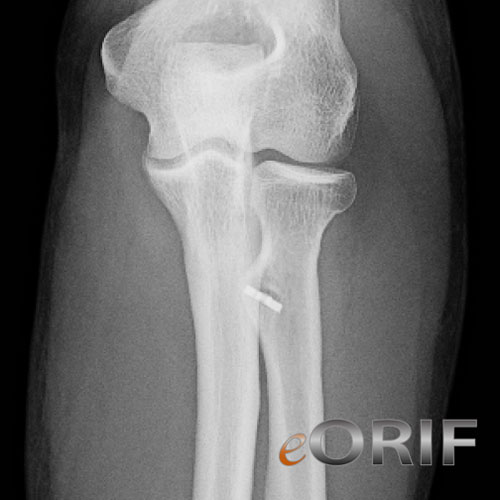 Distal Biceps Tendon Rupture Images | eORIF